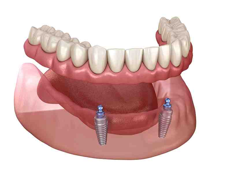 How long are gums sore after implant surgery?