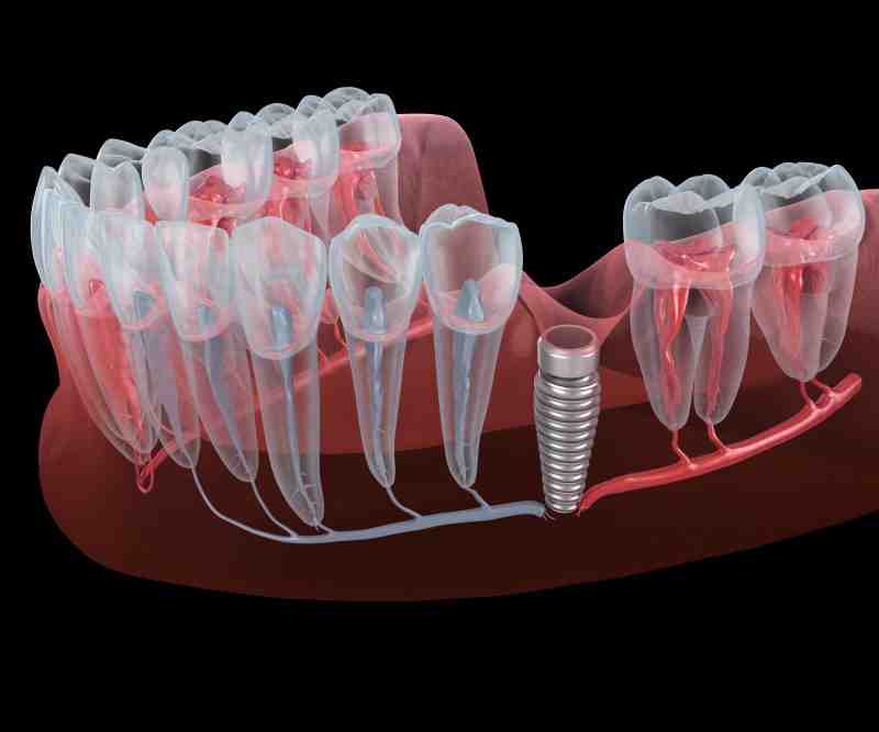 How long are implants guaranteed for?