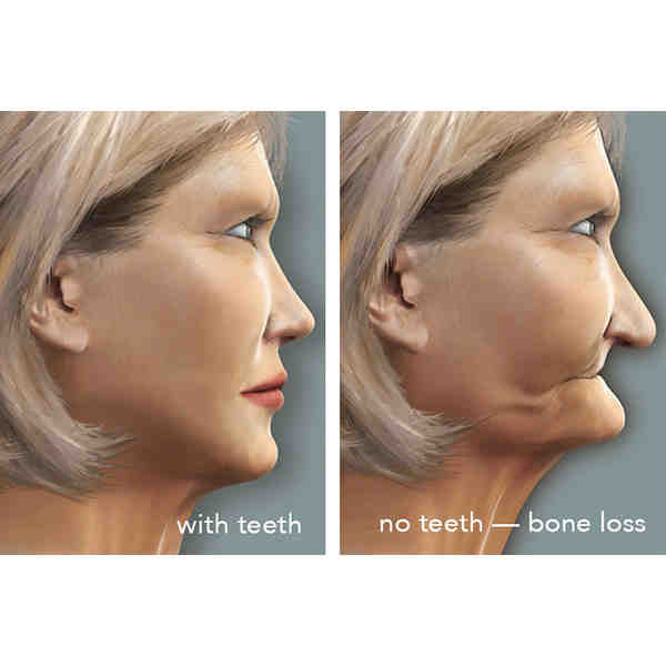 How long can you wait to get a bone graft after tooth extraction?