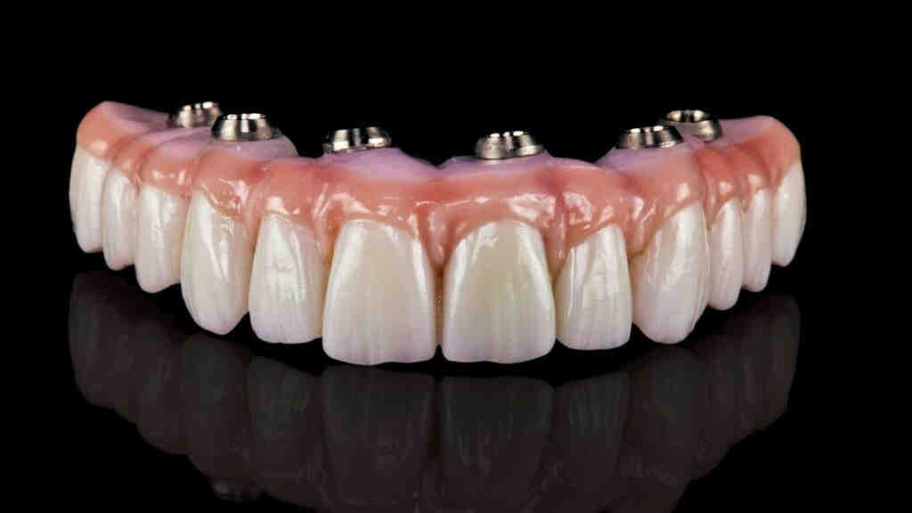 How long do all on 6 dental implants last?