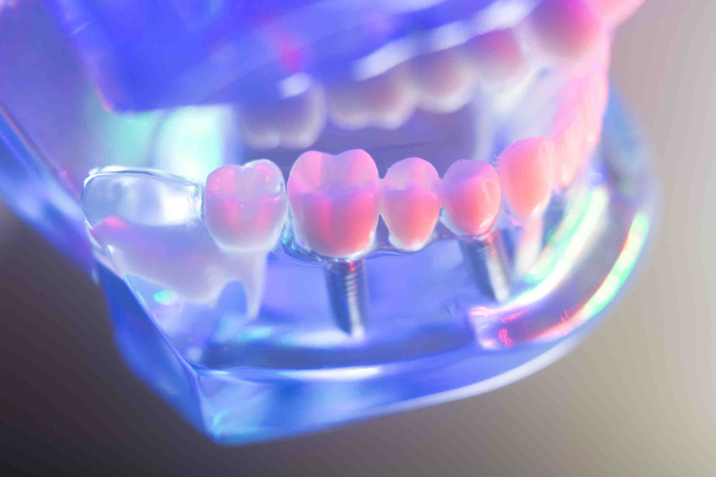 How long do dental implants last on average?