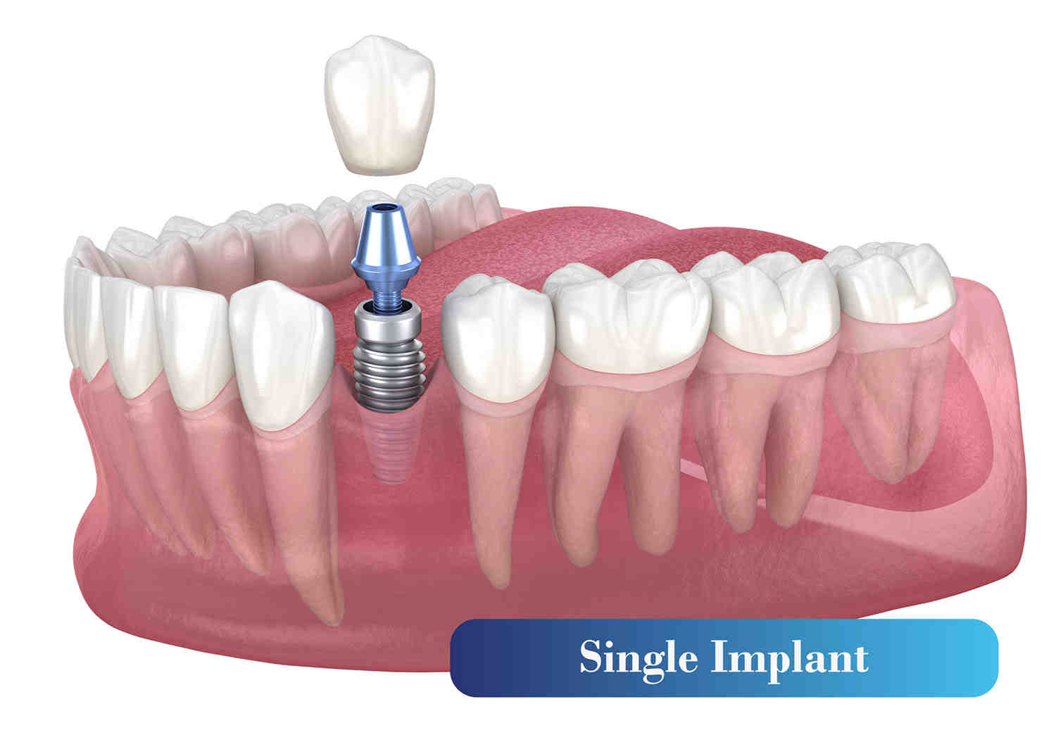 How long do full mouth implants last?