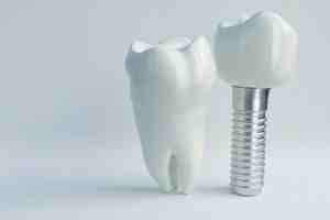 How long do implants last?