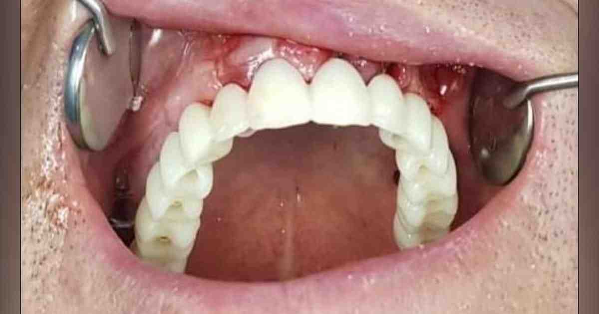How long do implants last?