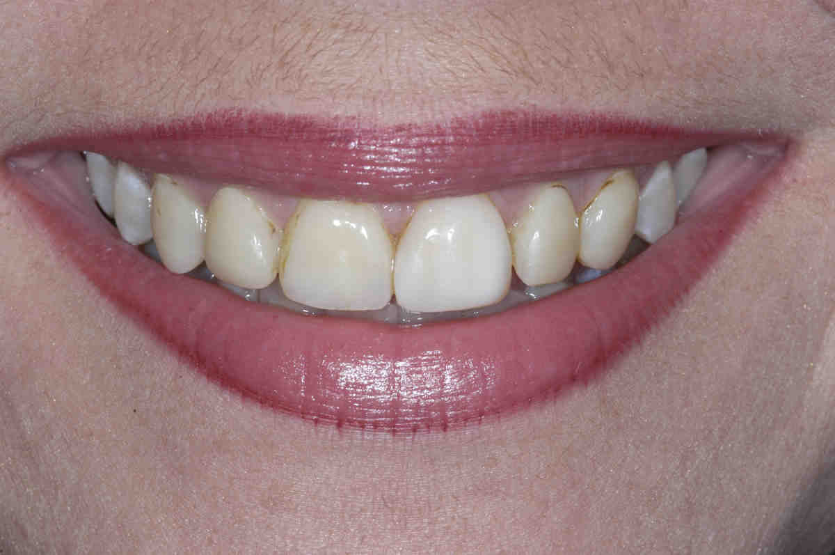 How long do porcelain veneers last?