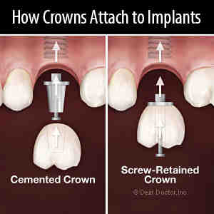 How long do root canals hurt?