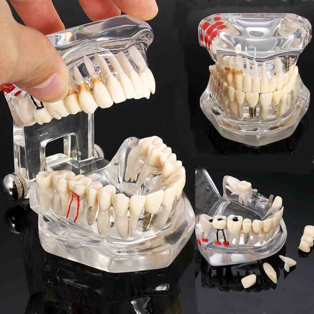 How long do stitches stay in after dental implant?