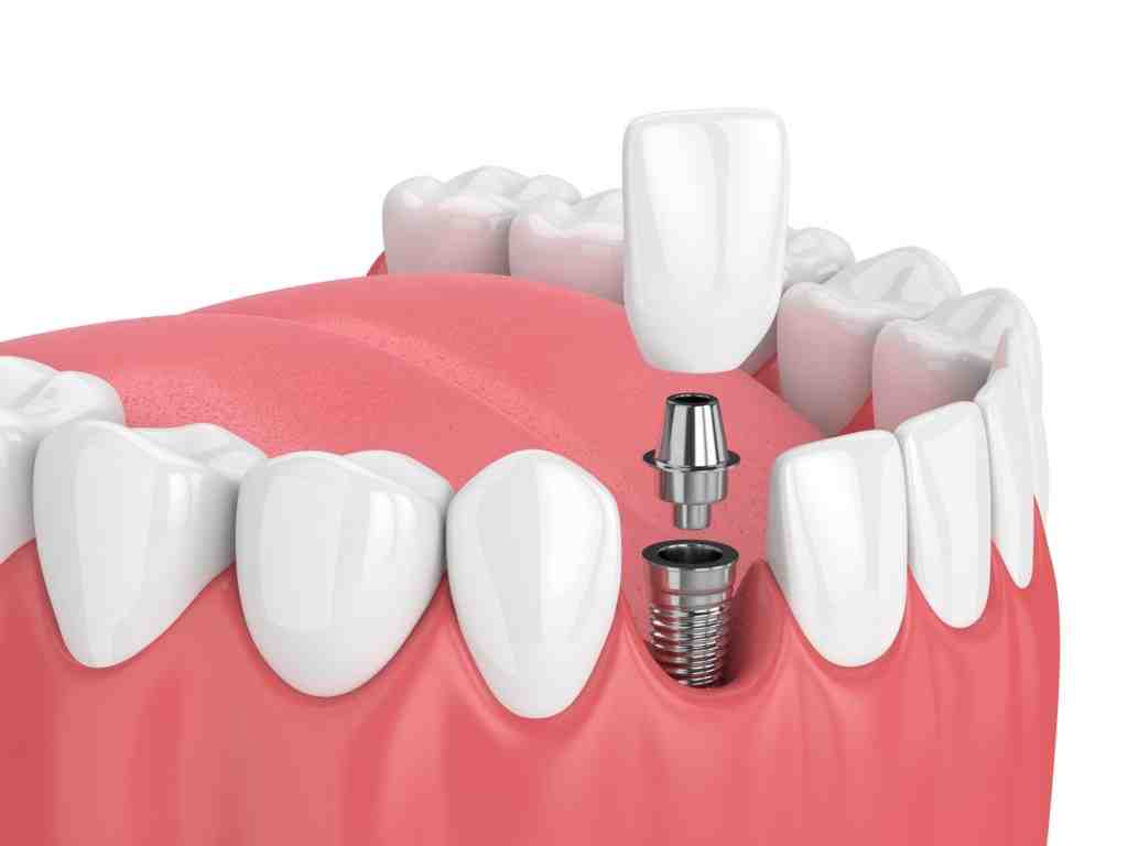How long do teeth implants last for?