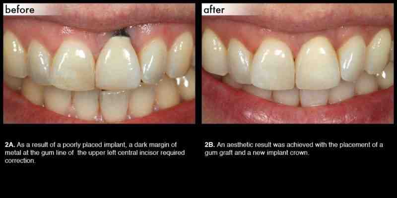 How long do titanium dental implants last?