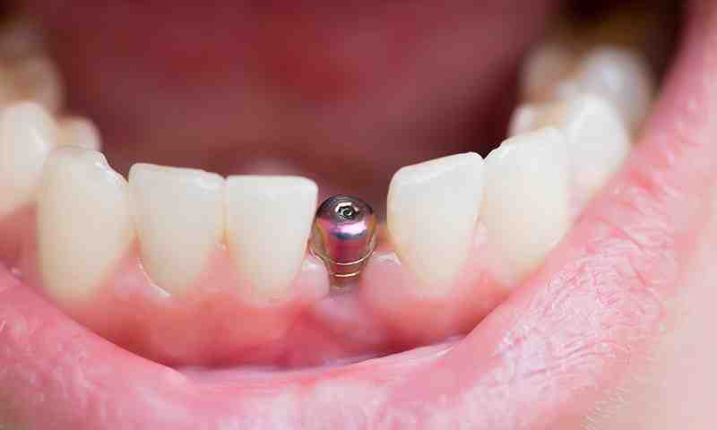 How long do titanium implants last?