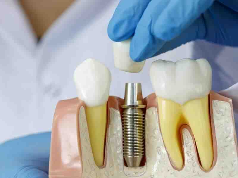 How long do titanium implants last?