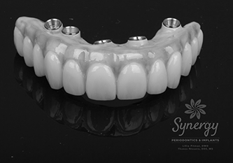 How long do titanium implants last?