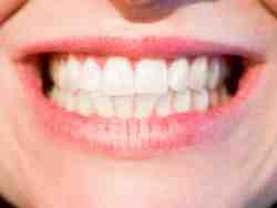 How long do you have to eat soft food after dental implant?