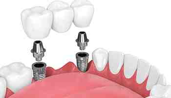 How long does a dental implant last for?