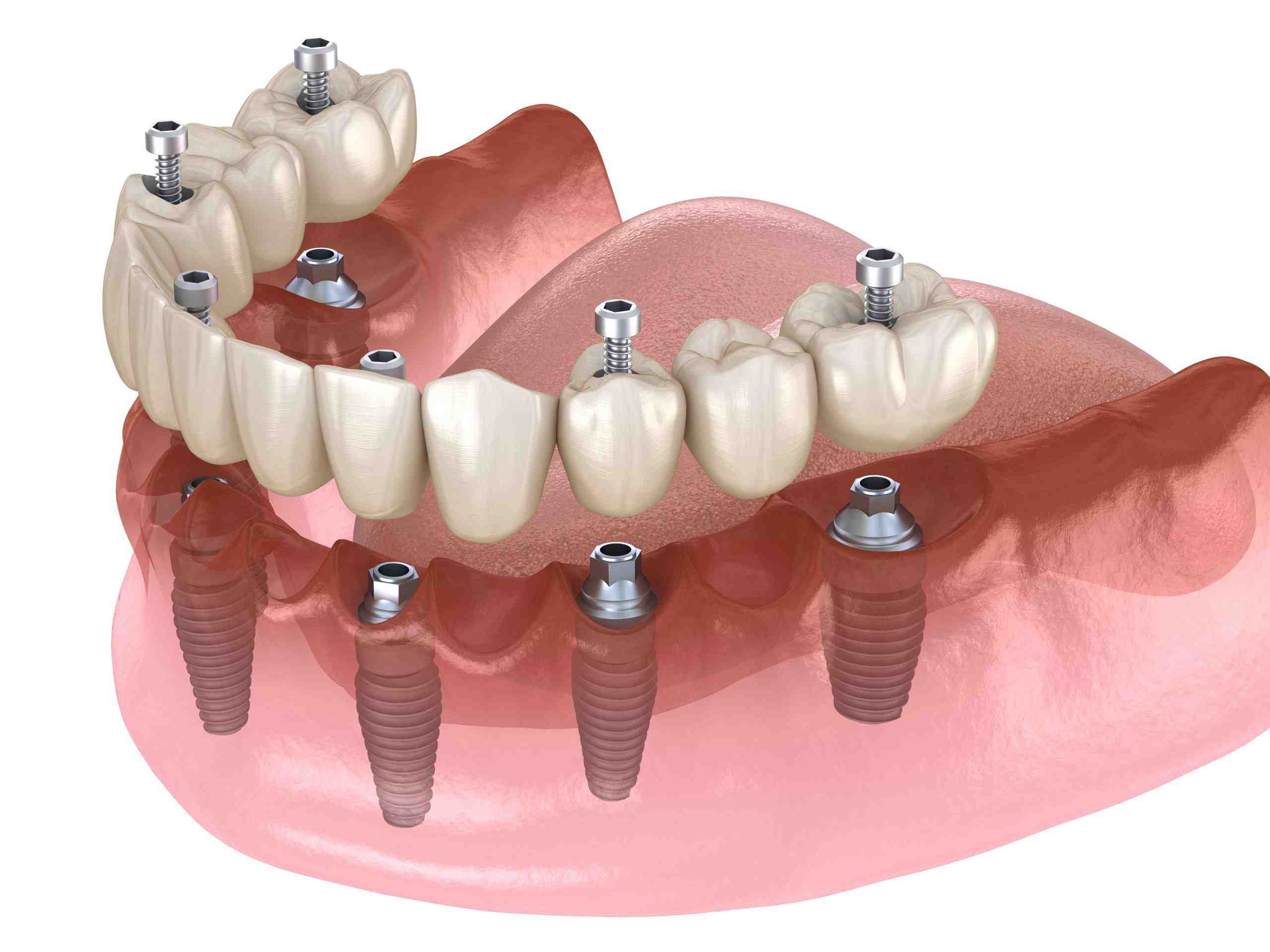 How long does a dental implant procedure take?