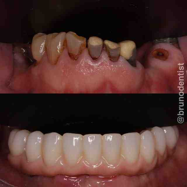 How long does a dental implant procedure take?