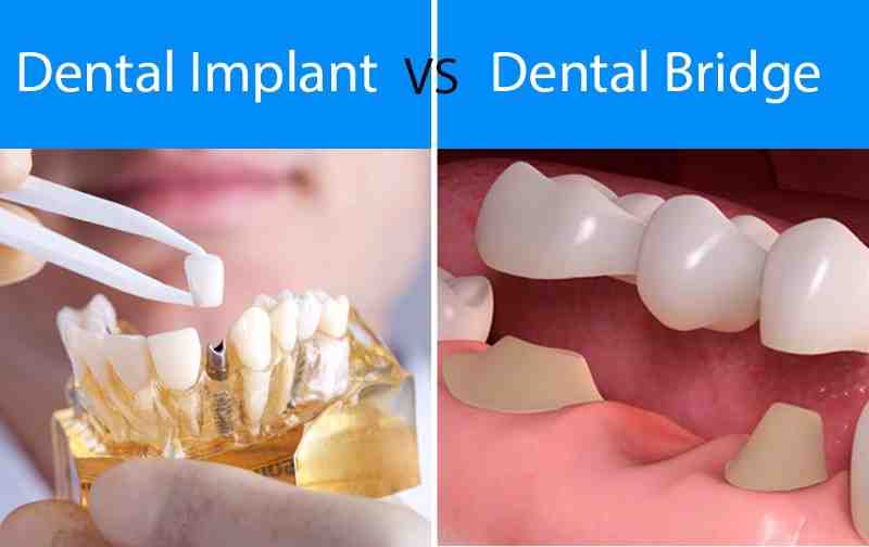 How long does a dental implant take to put in?