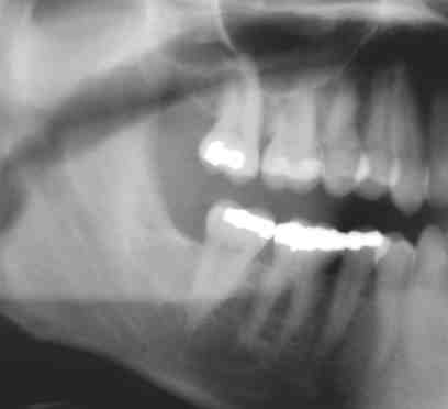How long does a dental implant take to put in?