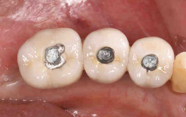 How long does an implant screw last?