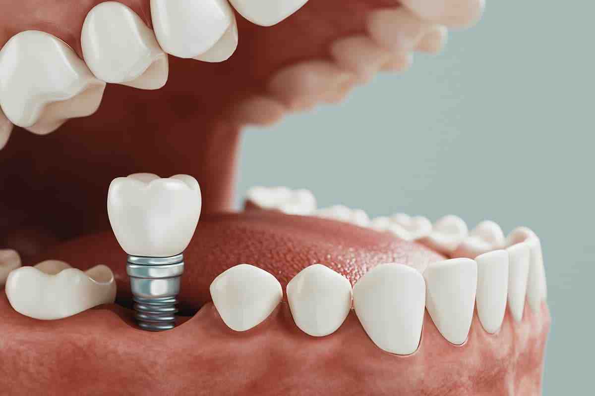 How long does dental implant surgery take?