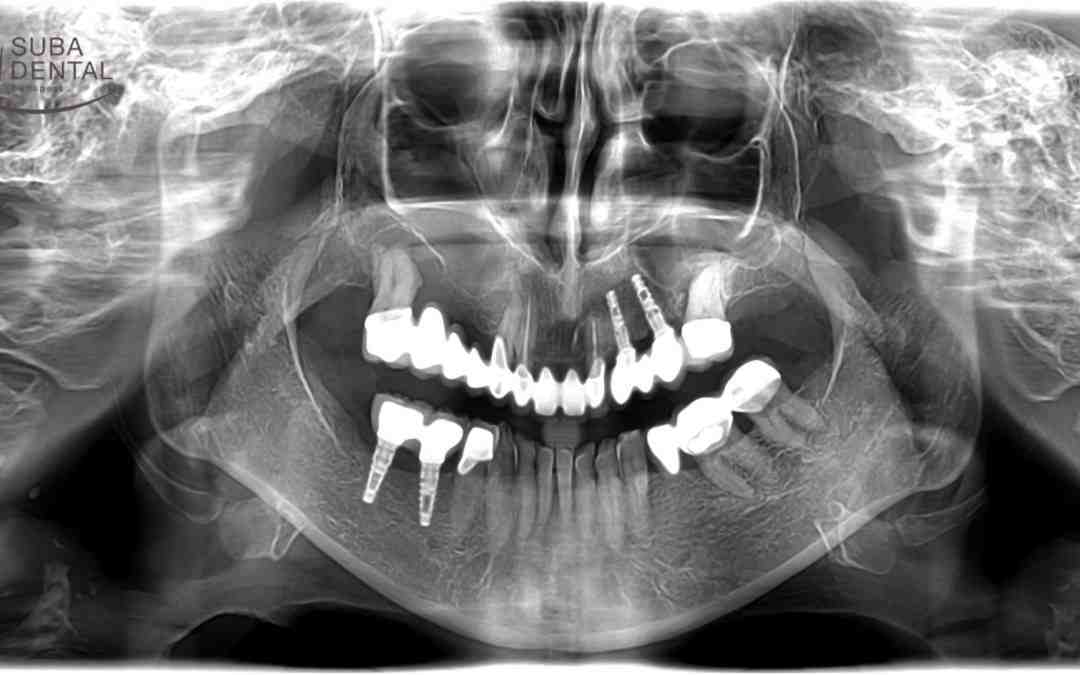 How long does it take dissolvable stitches to dissolve in mouth?
