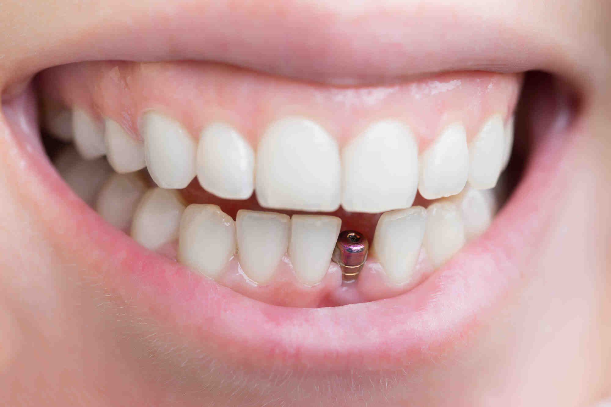 How long does it take for a diabetic to heal after tooth extraction?