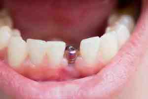 How long does it take for bone to grow around dental implant?