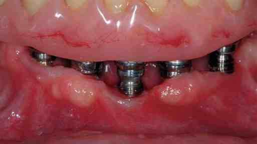How long does it take for dental bone graft to harden?
