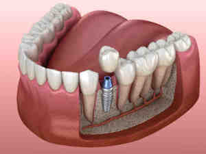 How long does it take for dental implant stitches to dissolve?