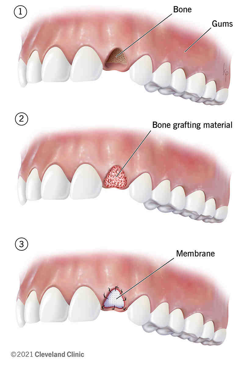 How long does it take for dental implant to fuse to bone?