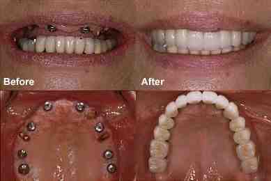 How long does it take for dental implants to fuse to bone?