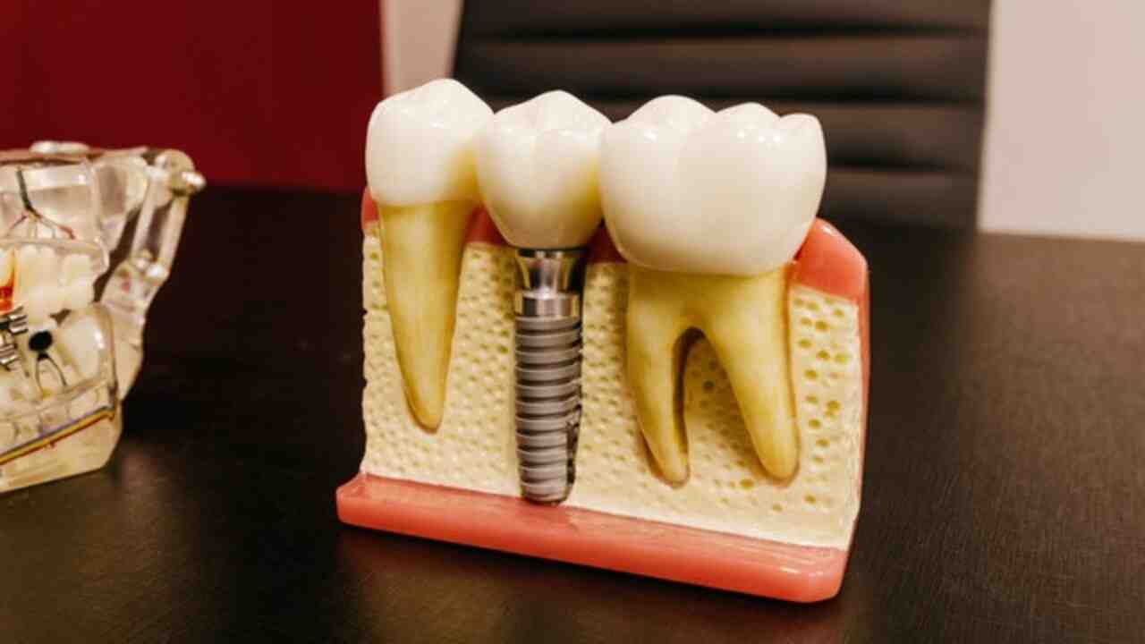 What to ask about dental implants - Dental News Network