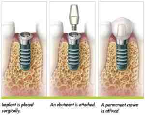 How long does it take for dental implants to fuse to bone?