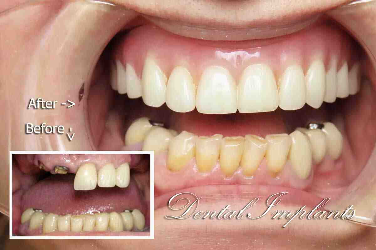 How long does it take for dental implants to fuse to bone?