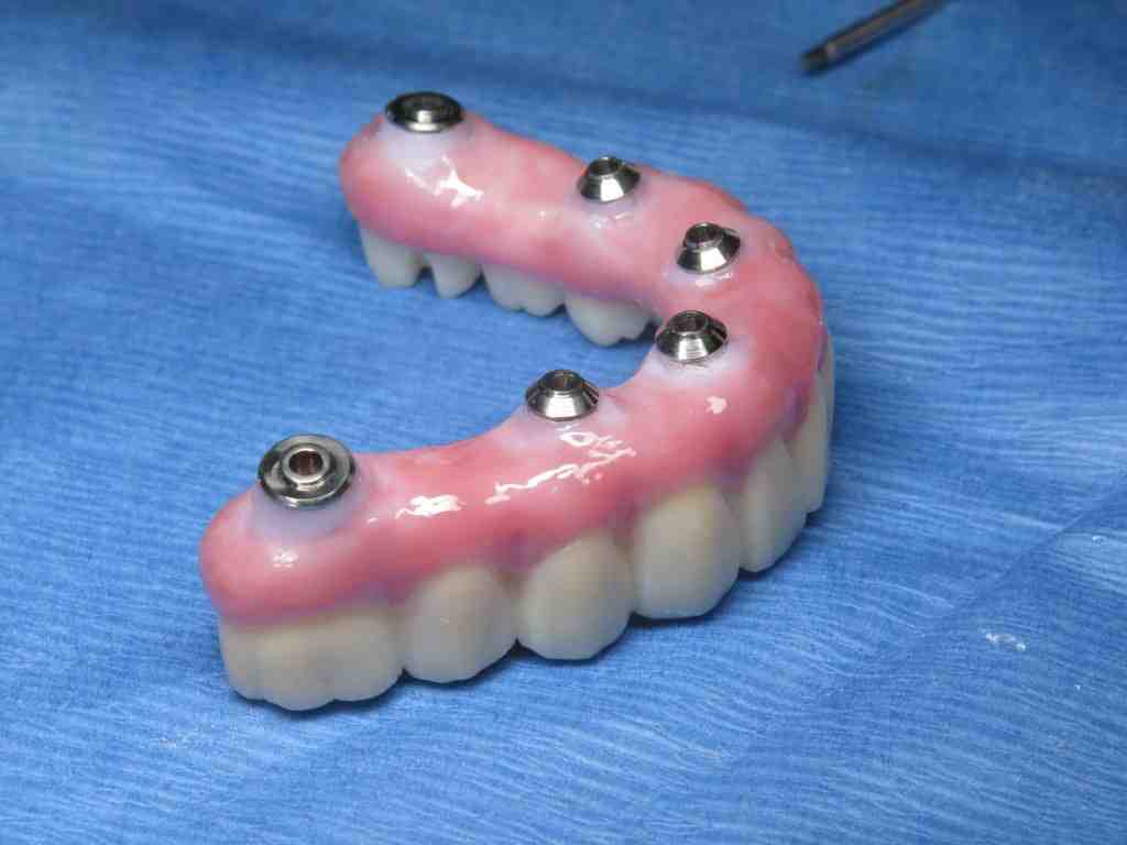 How long does it take for dental implants to fuse to bone?