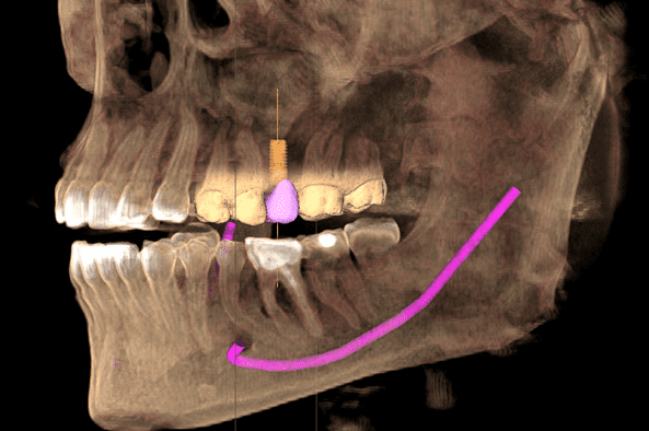 How long does it take for dental implants to fuse to bone?