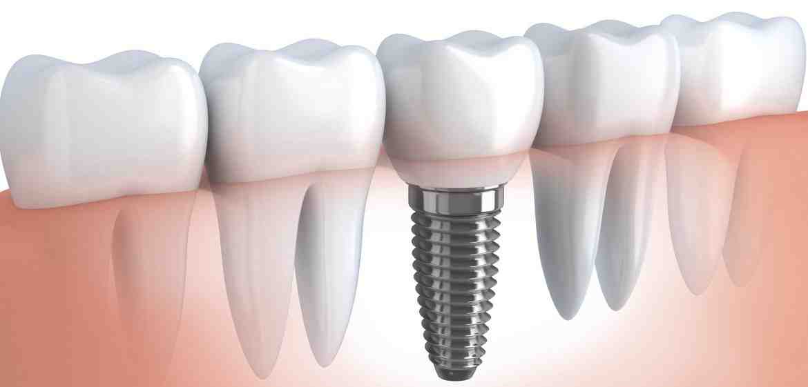 How long does it take for dental implants to heal?