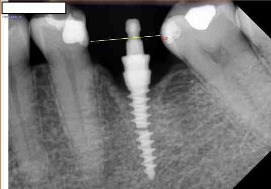 How long does it take for gums to heal after extractions for implants?