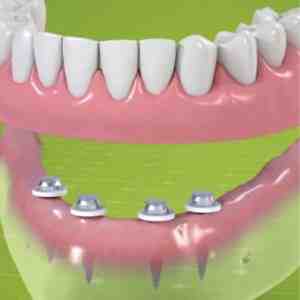 How long does it take for implant placement to heal?