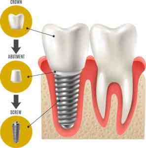 How long does it take for implants to heal?