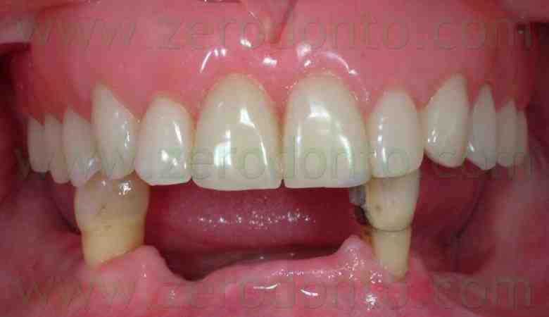 How long does it take for the implant to Osseointegrate to the bone?