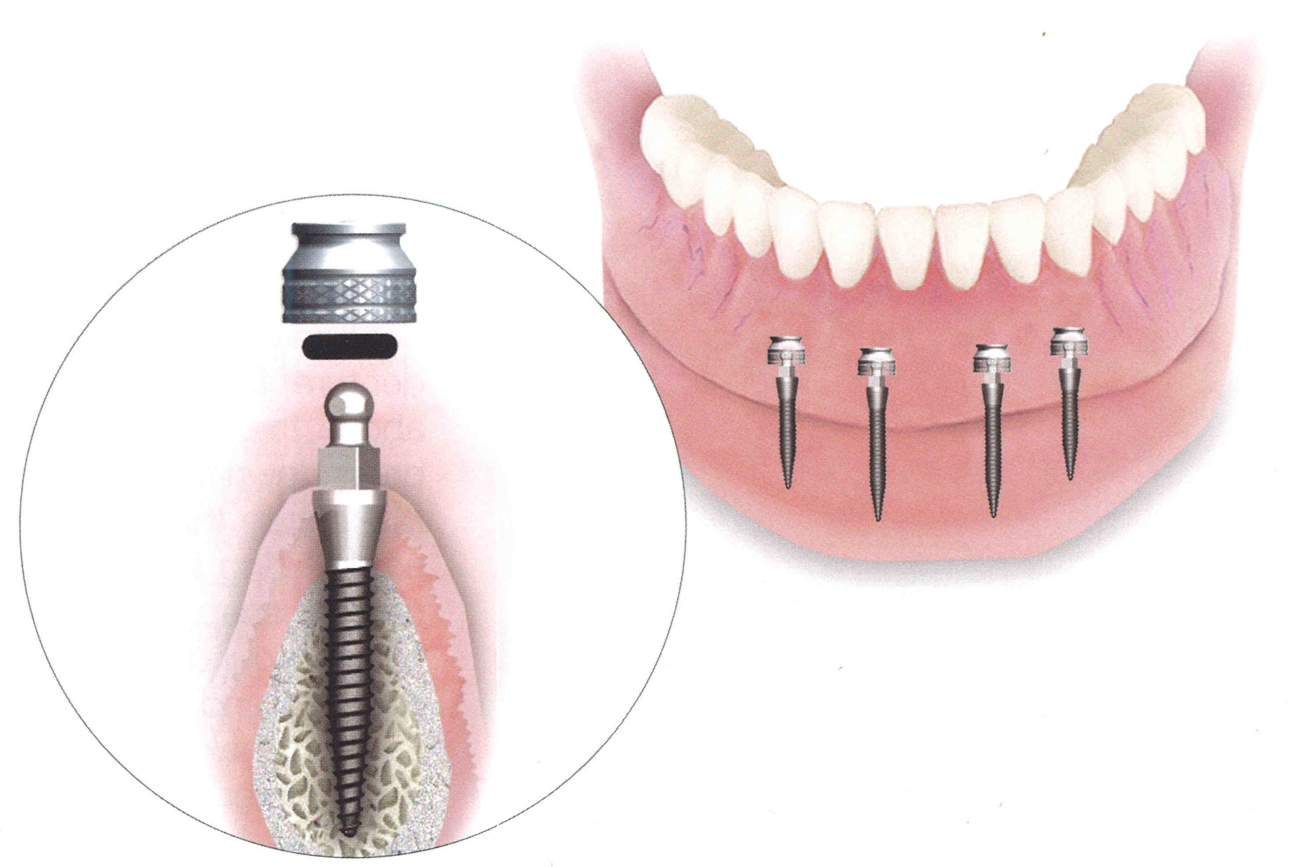 How long does it take for your gum to heal after dental implant?