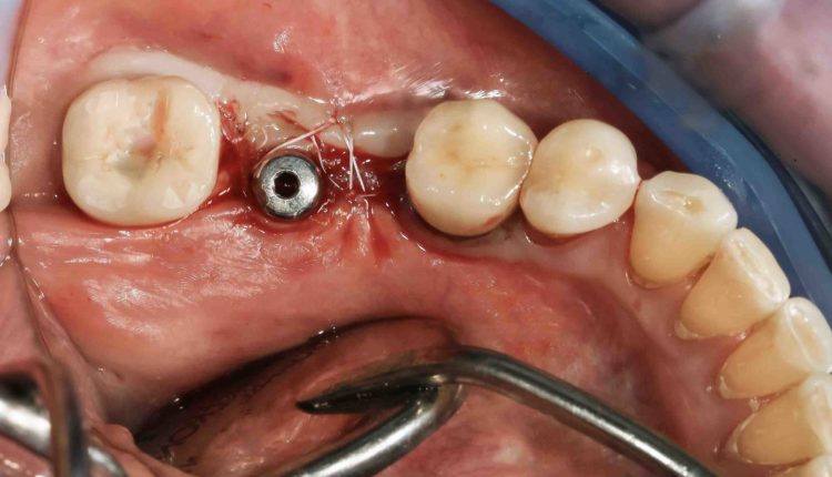 How long does it take to heal from dental implants