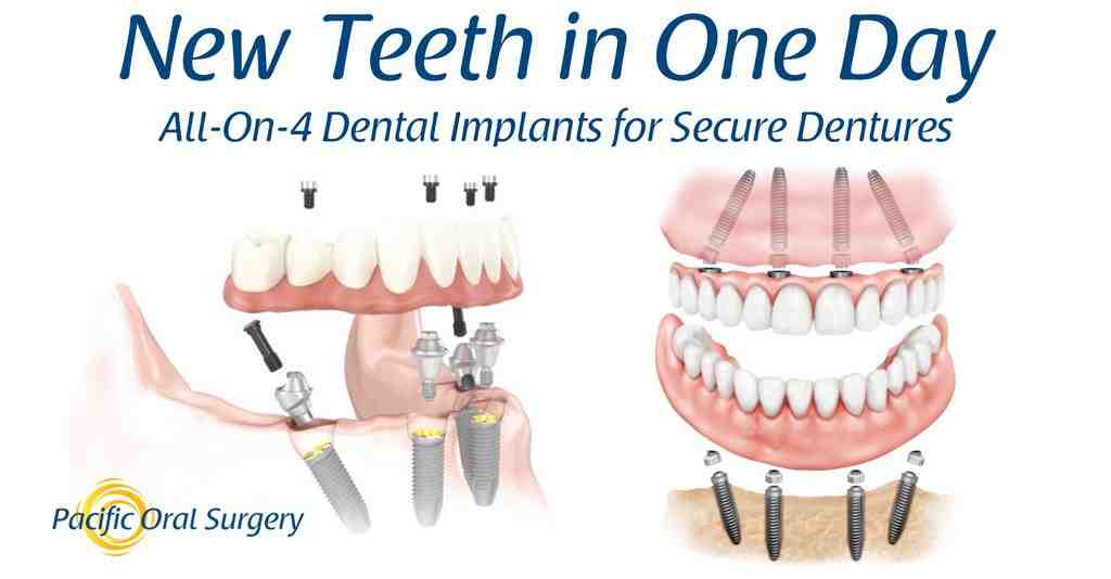 How long does jaw pain last after dental implant?