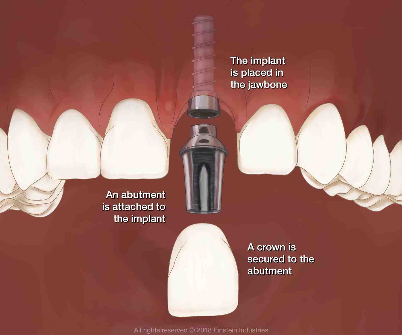 How long does the pain last after a dental implant?