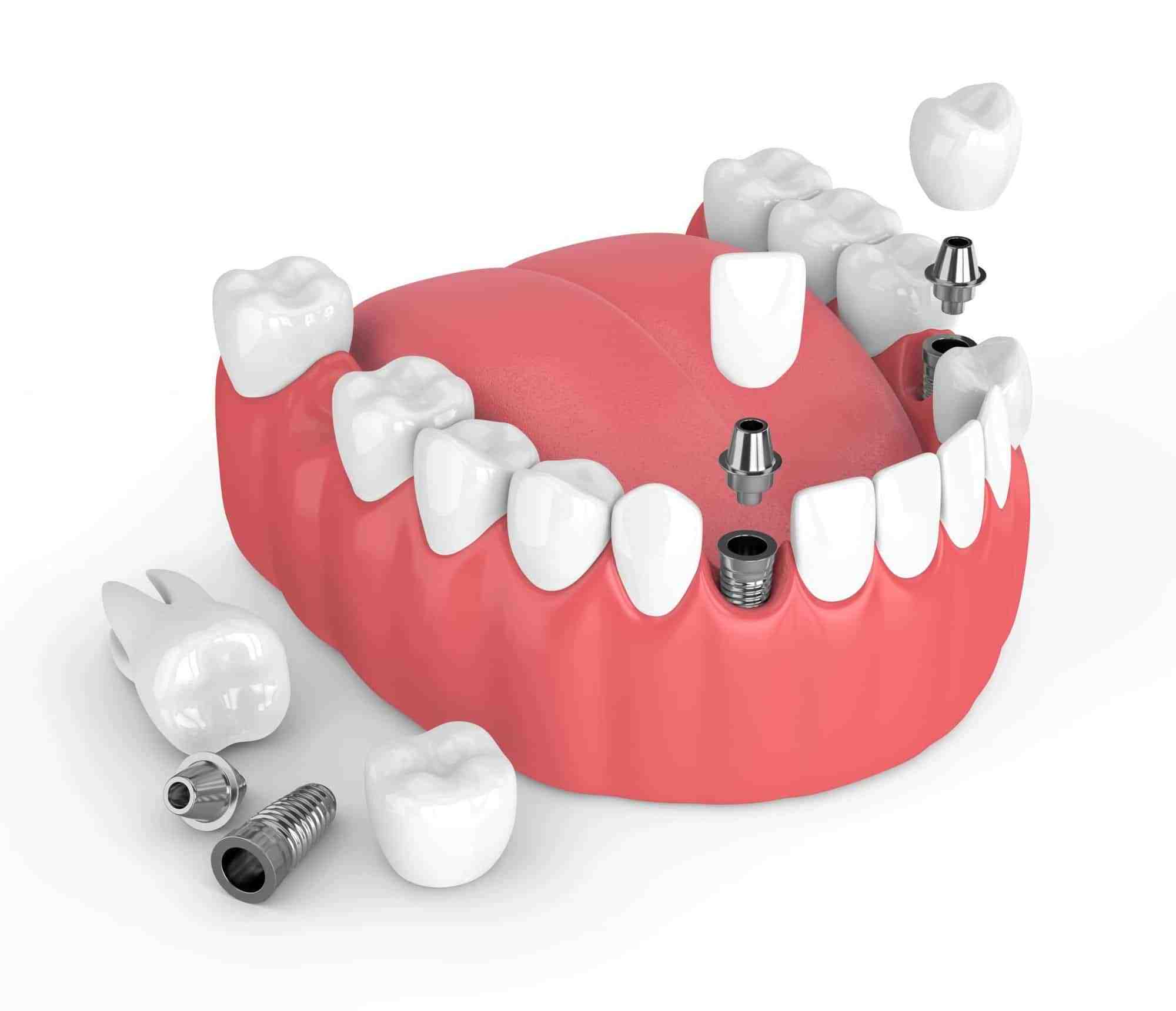 How long does the pain last after a dental implant?