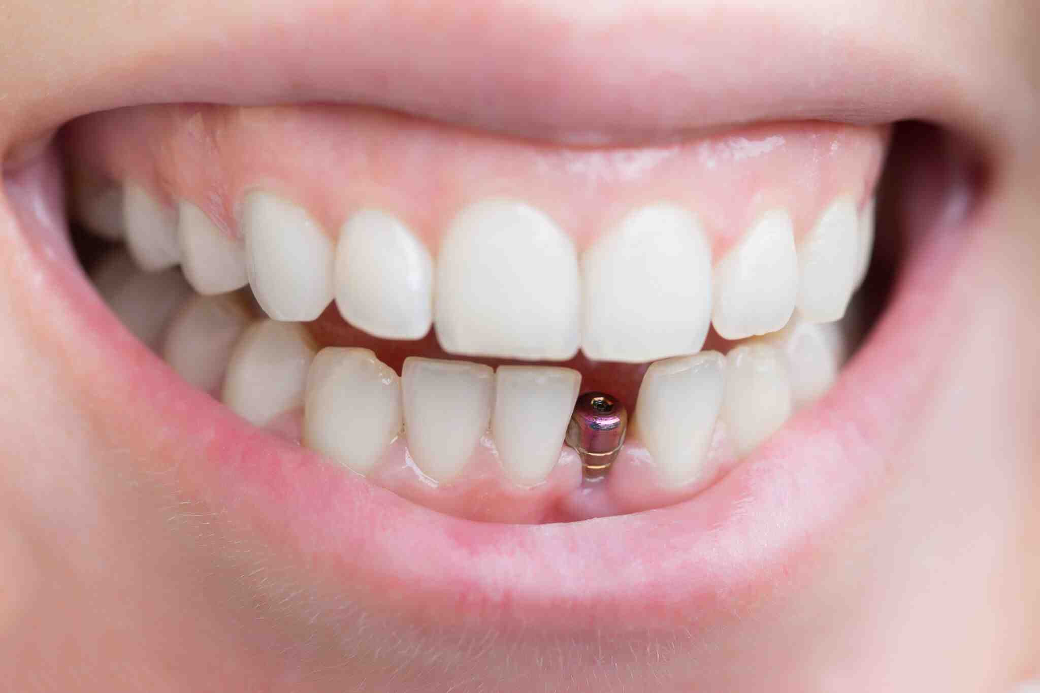How long does your mouth hurt after a dental implant?