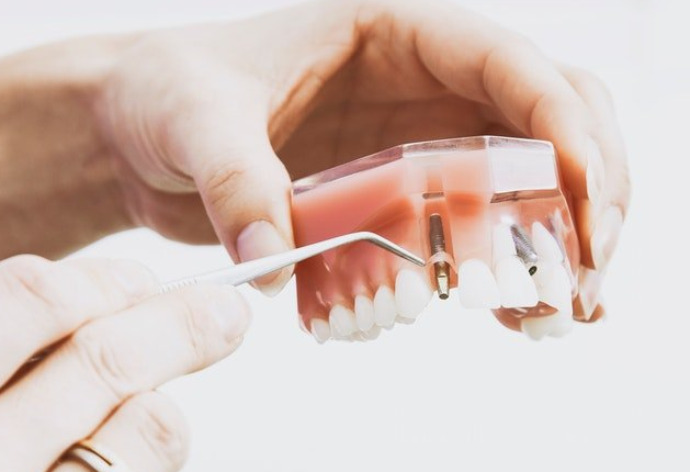 How long is dental implant process