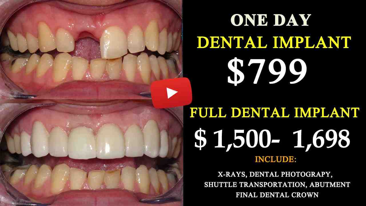 How long is the healing period for the first Osseointegrated implant surgery?
