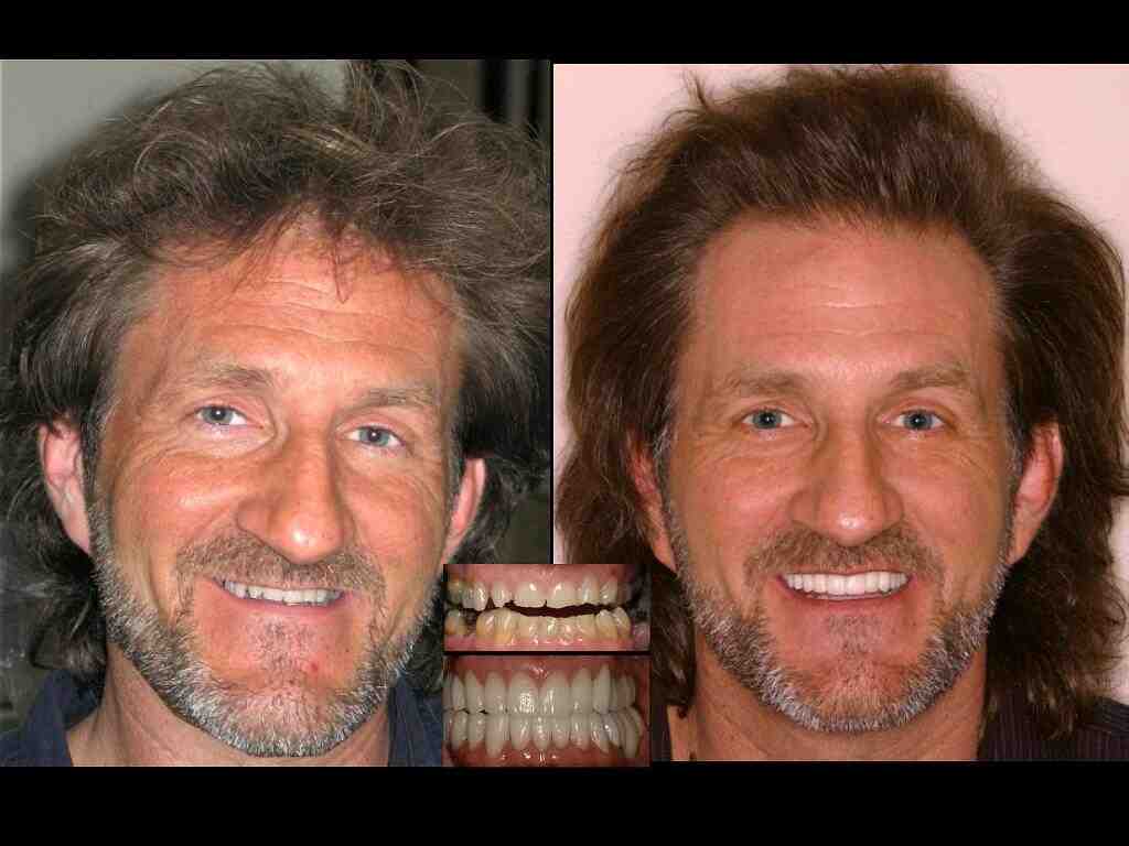 How long is the process of getting dental implants?